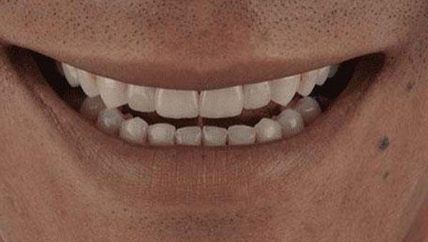 porcelain-002-after porcelain veneers patient 002 after