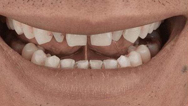 porcelain-002-b4 porcelain veneers patient 002 before