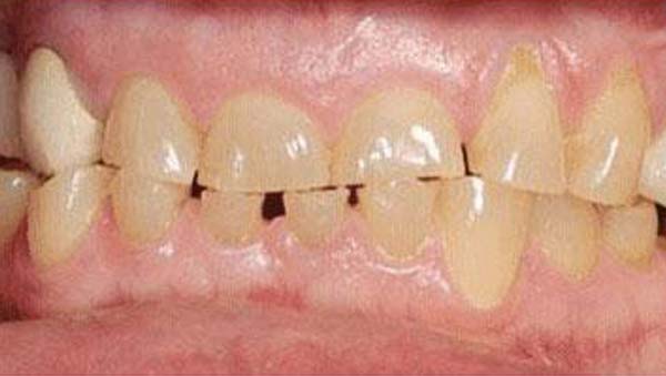 porcelain-003-b4 porcelain veneers patient 003 before