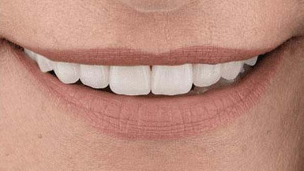 porcelain-005-after porcelain veneers patient 005 after