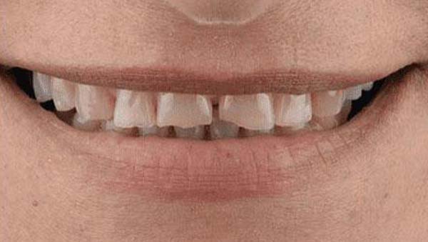 porcelain-005-b4 porcelain veneers patient 005 before
