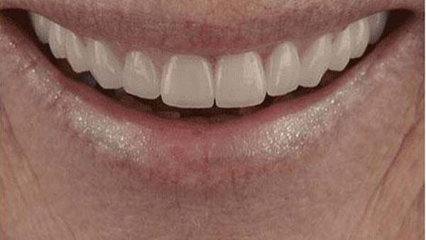 porcelain-006-after porcelain veneers patient 006 after
