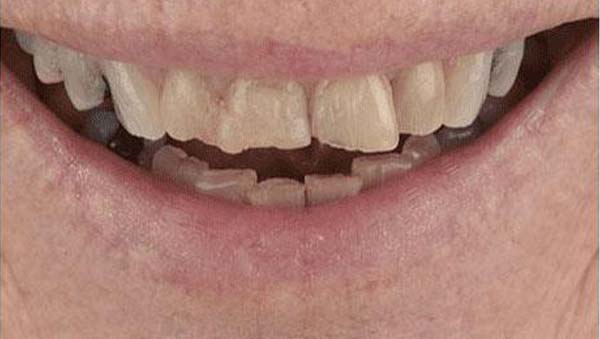 porcelain-006-b4 porcelain veneers patient 006 before