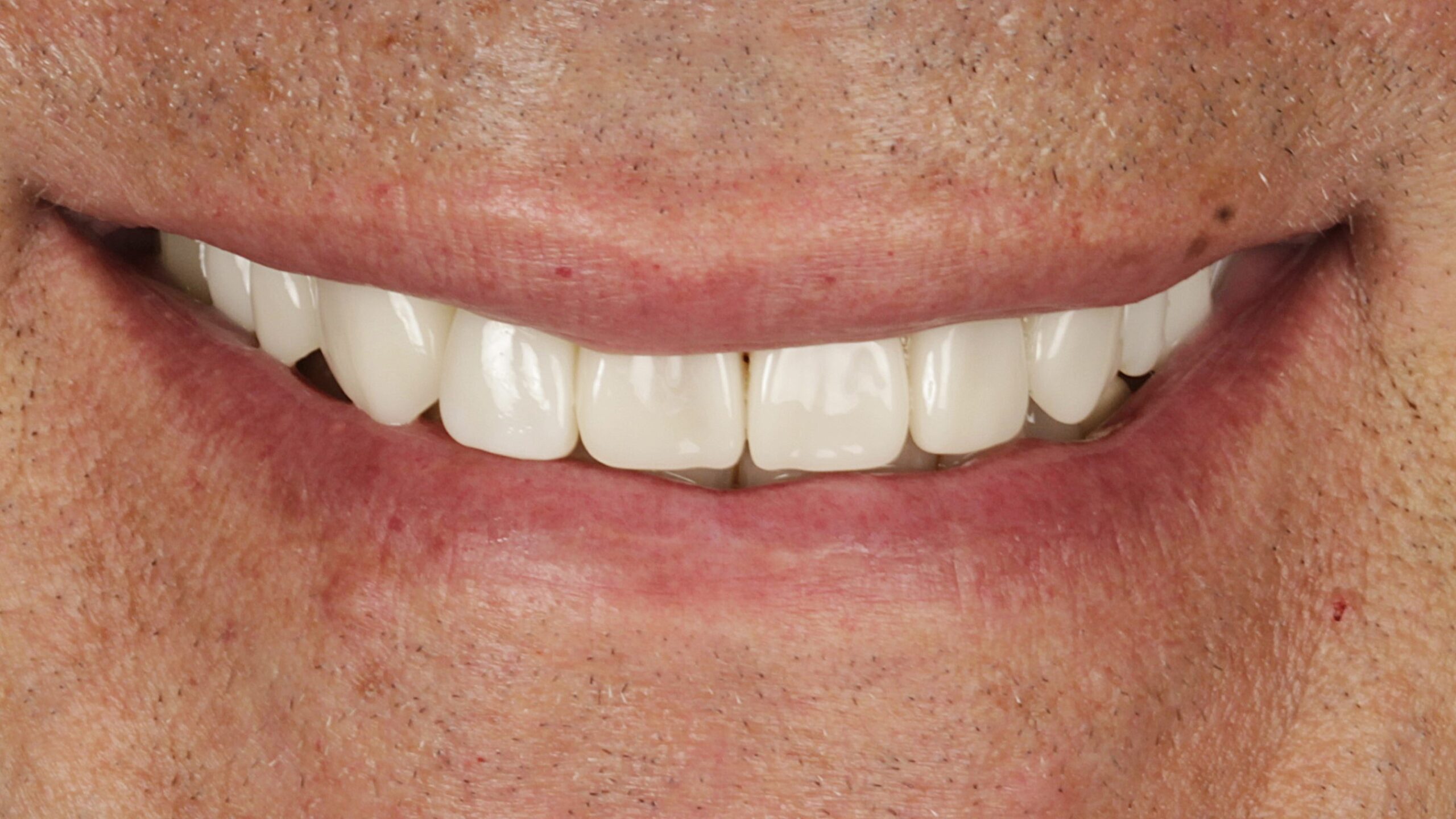1-Veneers and Implants after 1-Veneers and Implants after