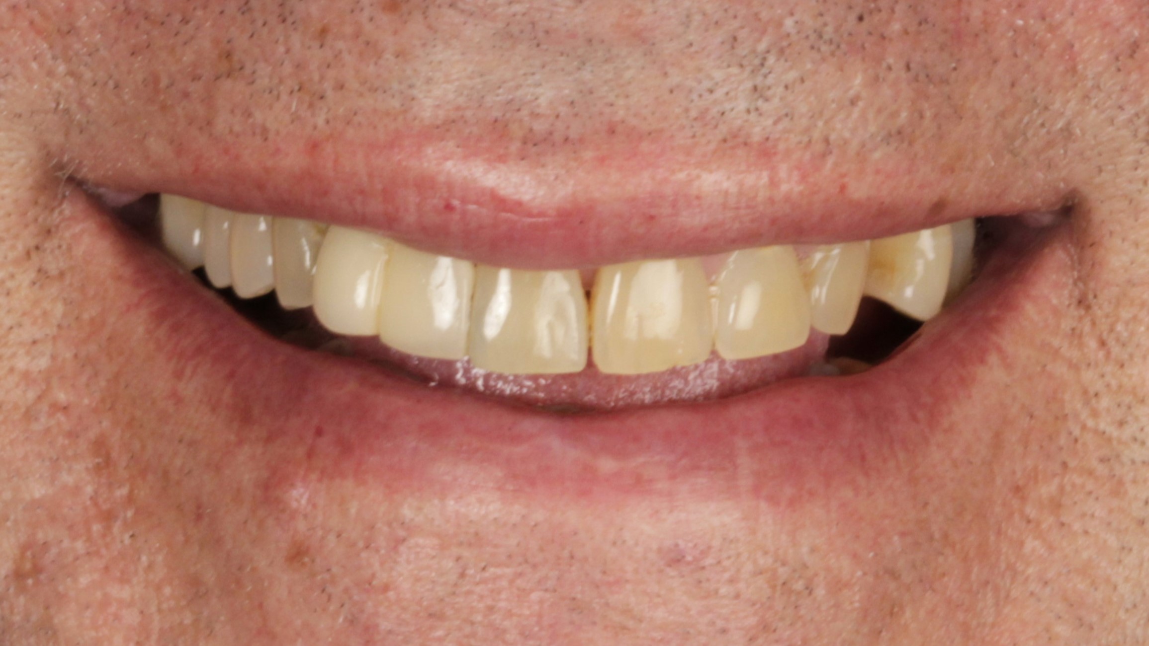 1 Veneers and Implants before 1 Veneers and Implants before
