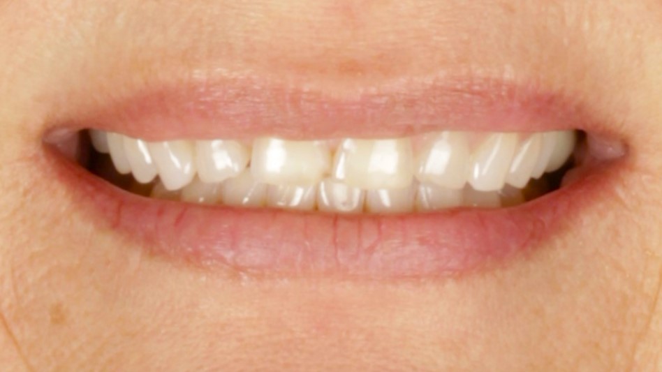 1 Veneers before 1 Veneers before