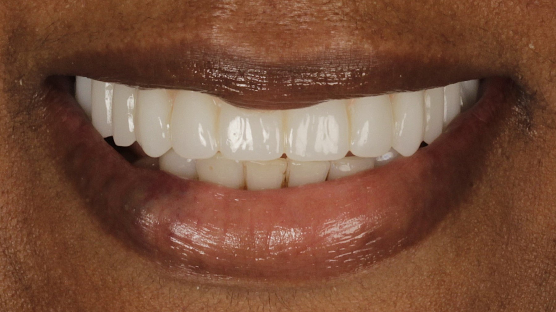 2-Single AO4 After 2-Single AO4 After