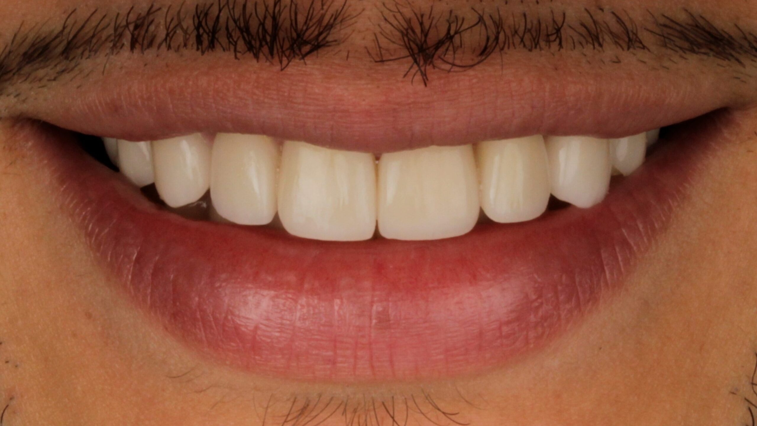 2-Veneers after 2-Veneers after