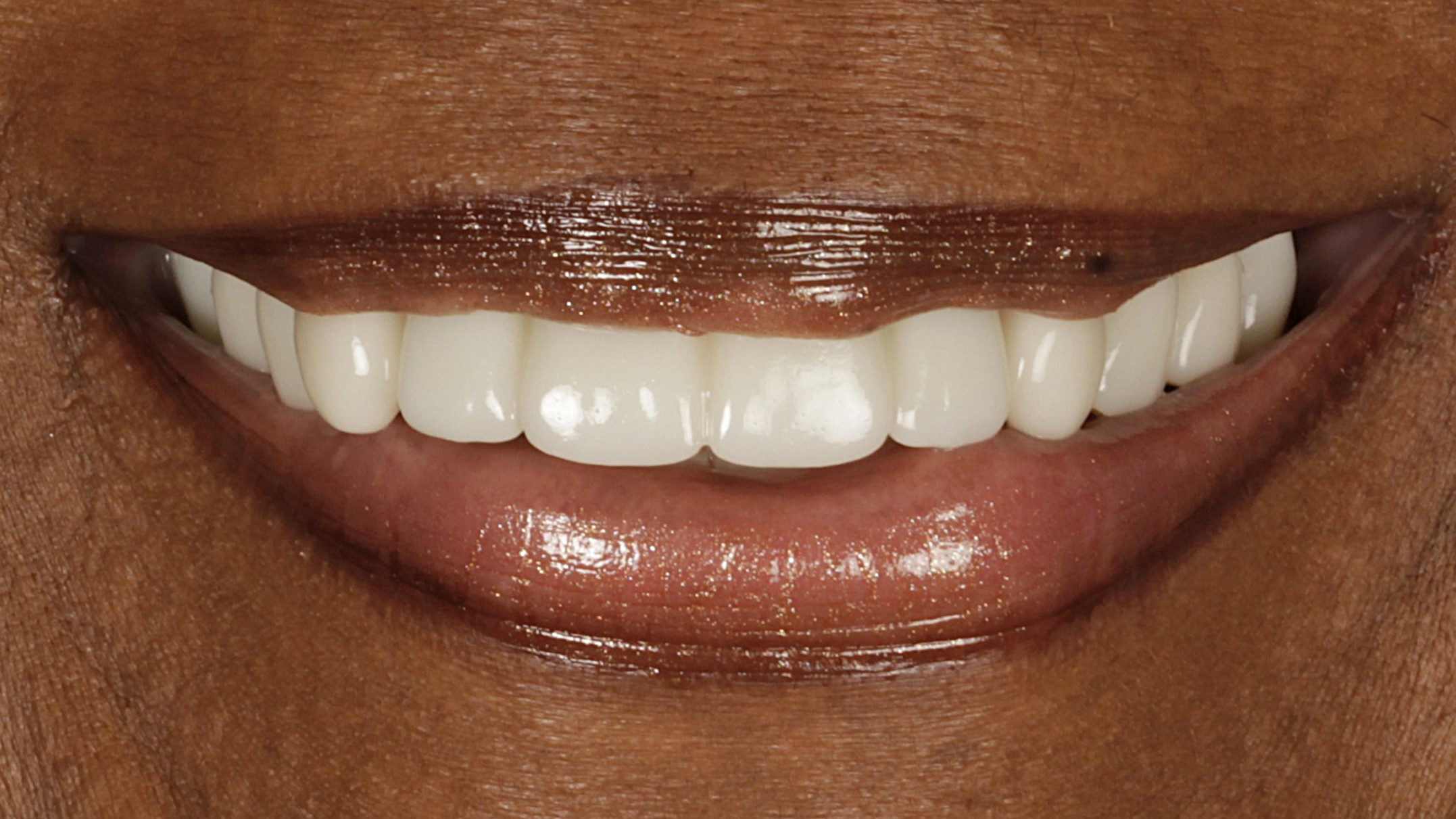 2-Veneers and Implants after 2-Veneers and Implants after