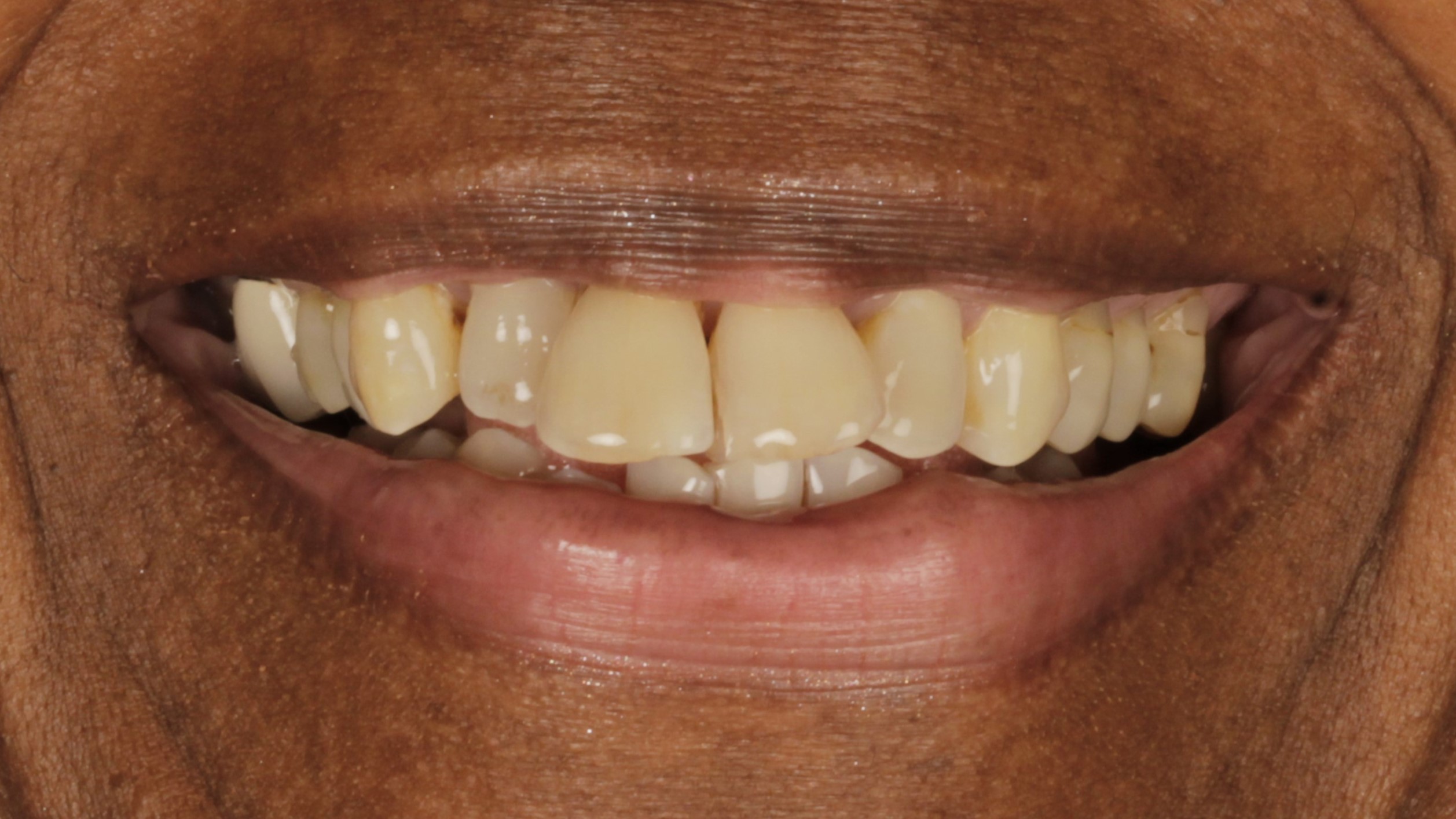 2 Veneers and Implants before 2 Veneers and Implants before