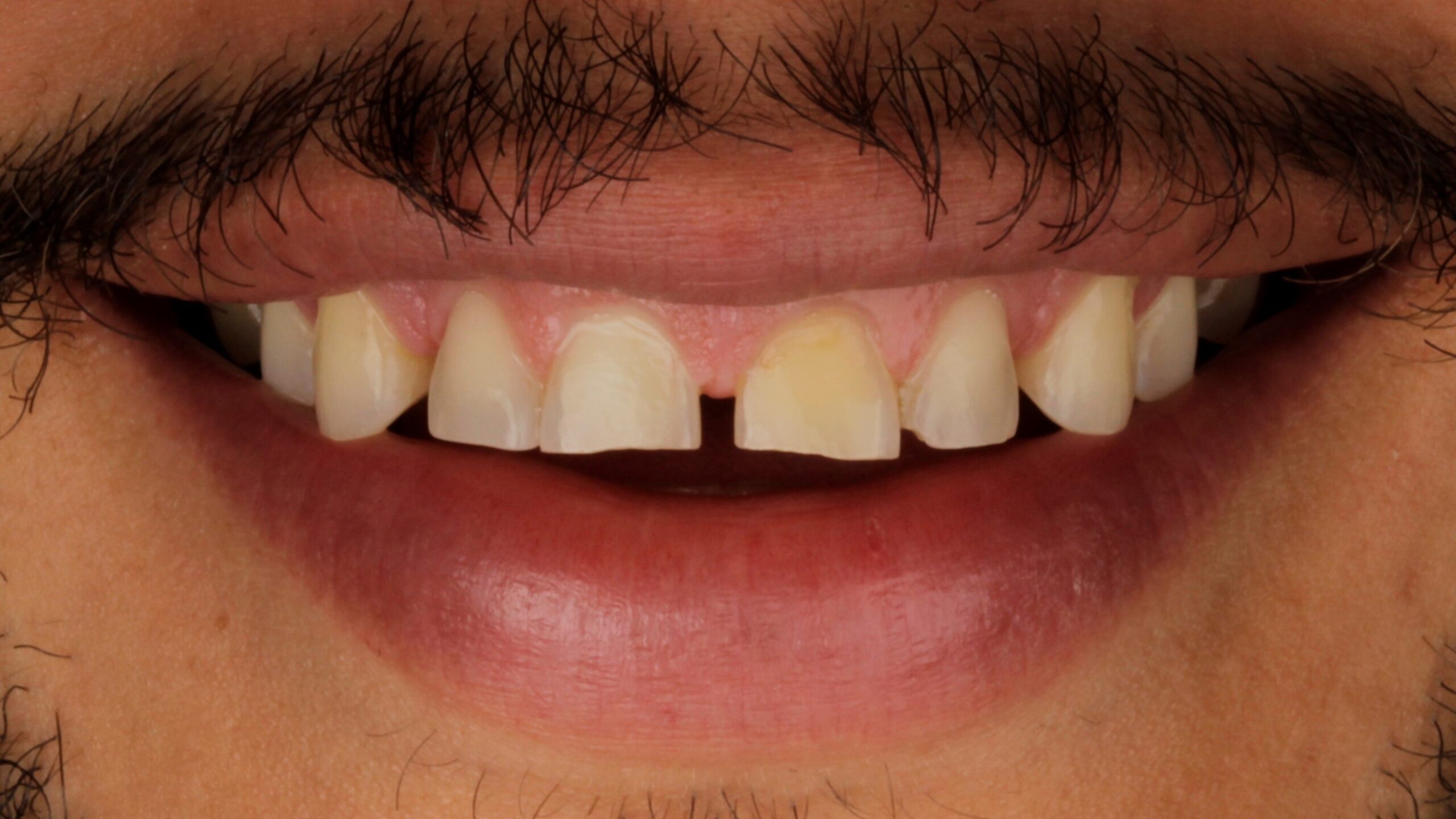 2 Veneers before 2 Veneers before