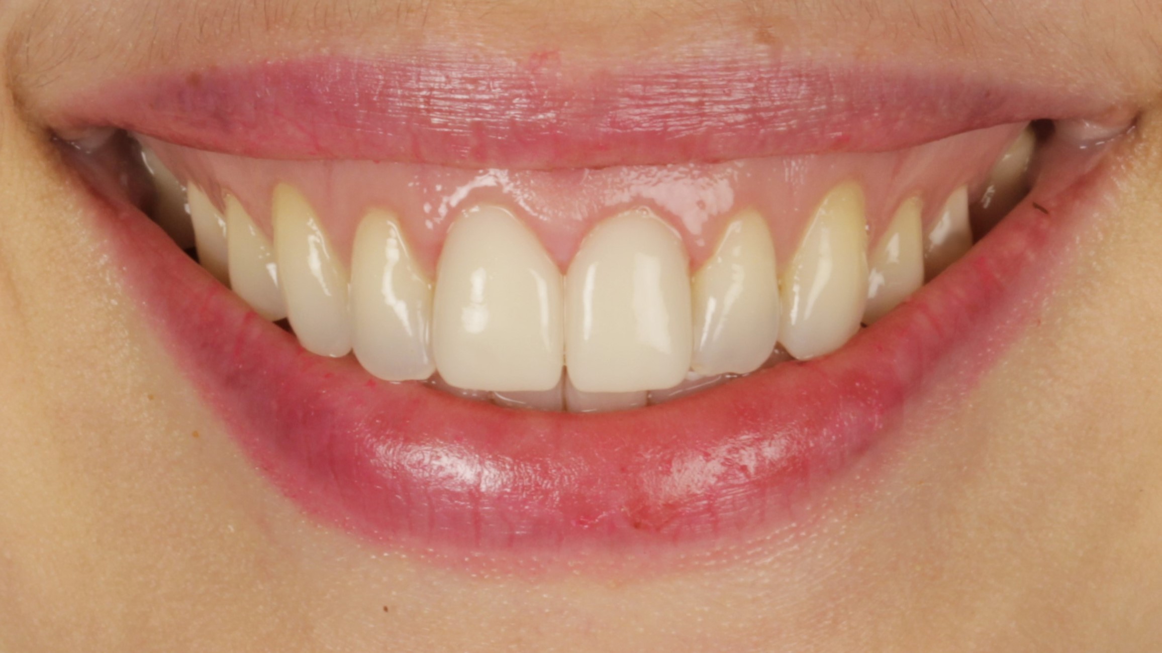 3-Veneers after 3-Veneers after