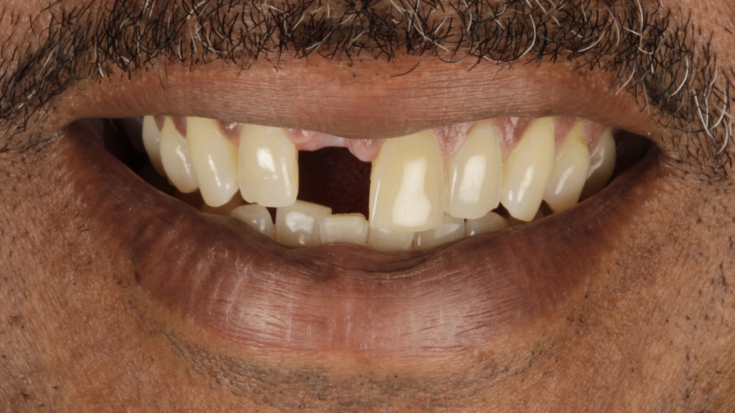 3 Veneers and Implants before 3 Veneers and Implants before