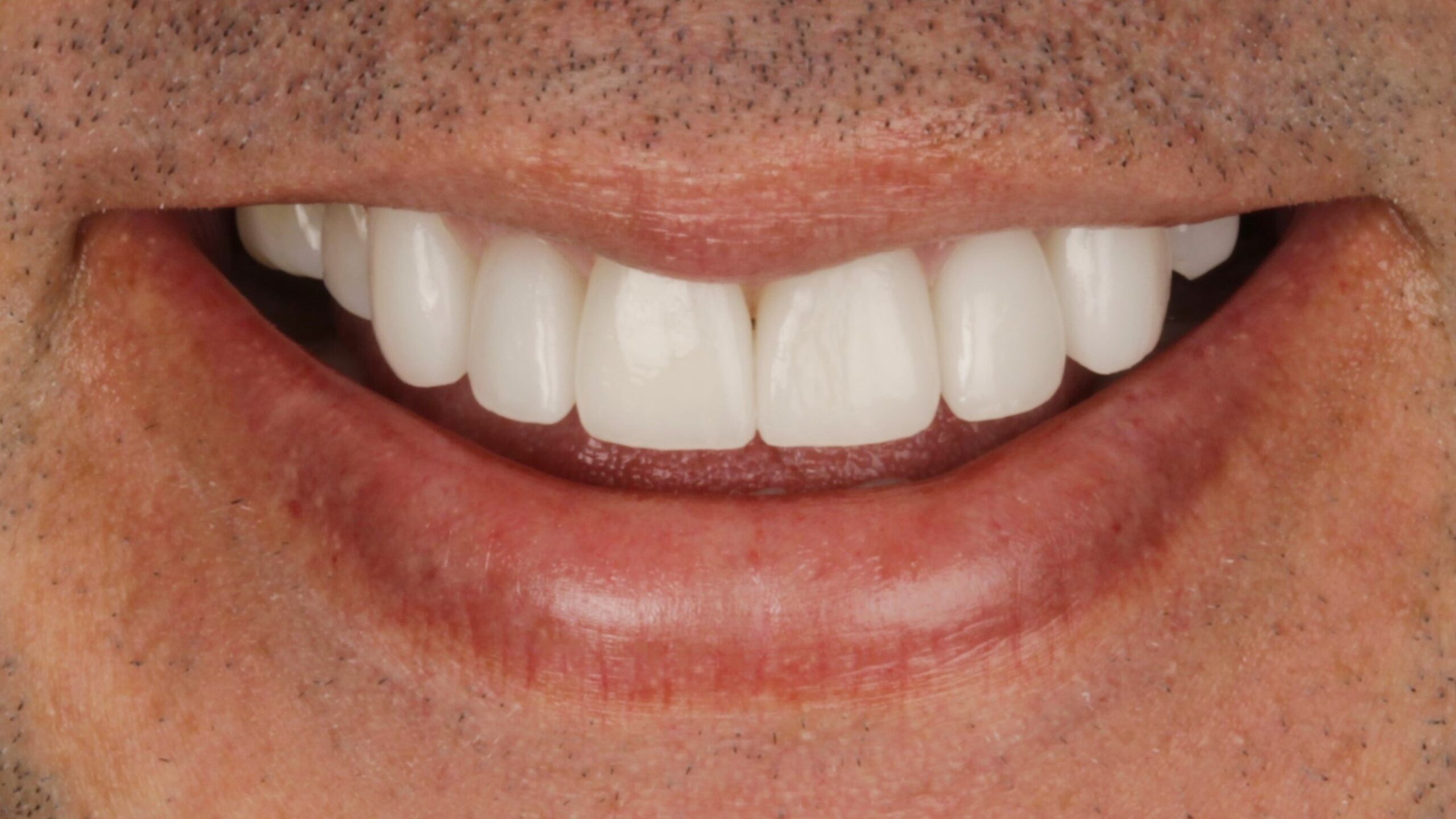 4-Veneers after 4-Veneers after