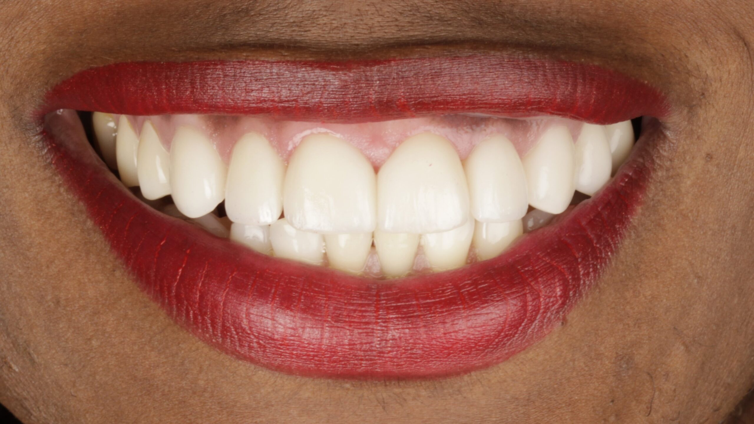 5-Veneers after 5-Veneers after