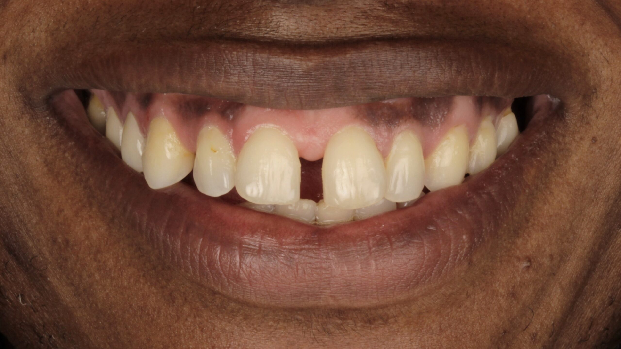 5 Veneers before 5 Veneers before
