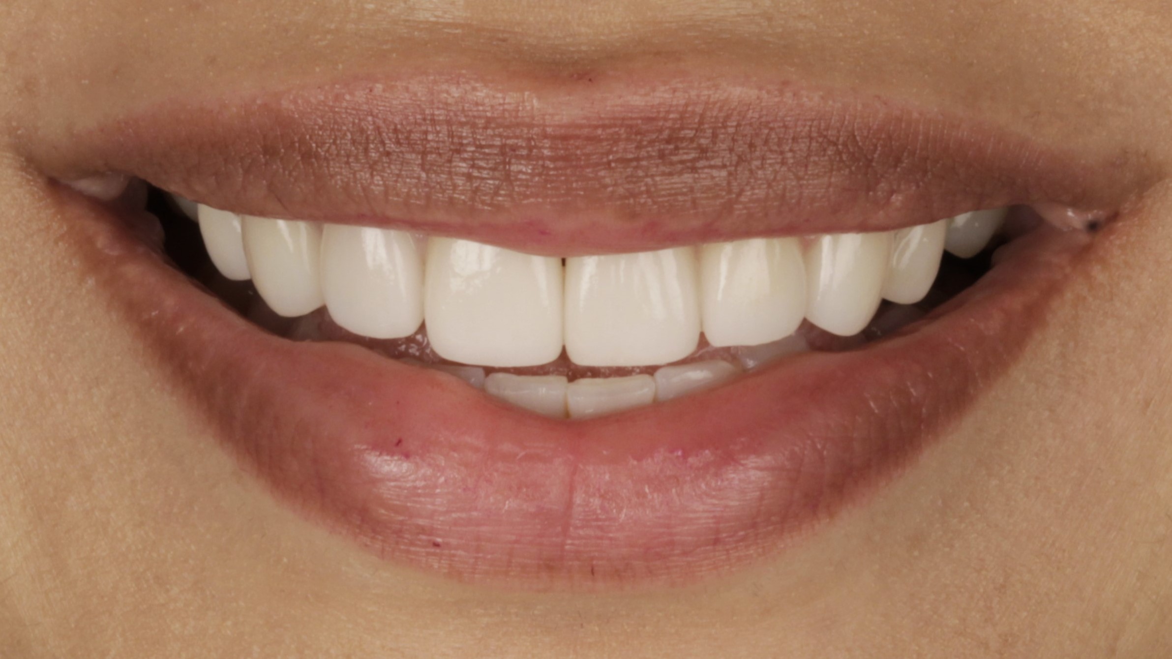 6-Veneers after 6-Veneers after