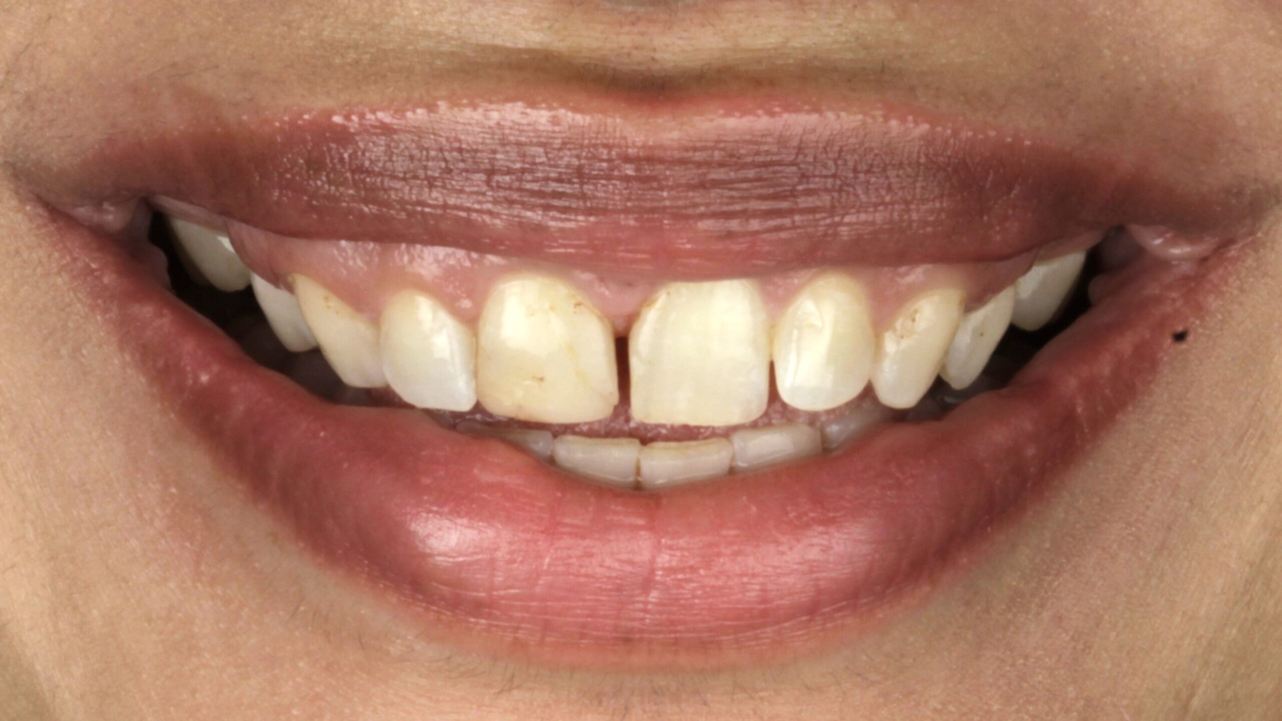 6 veneers before 6 veneers before