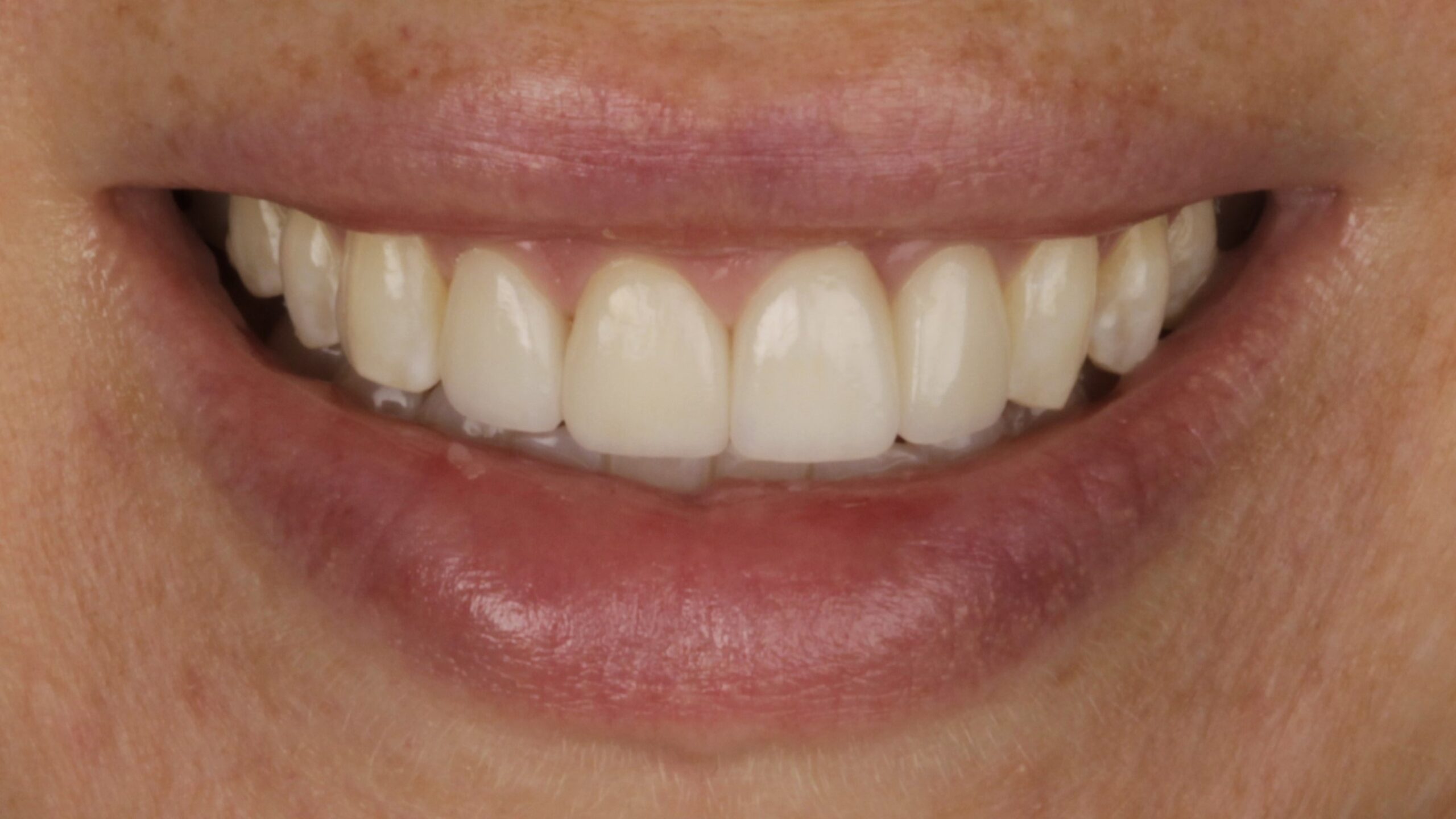 7-Veneers after 7-Veneers after