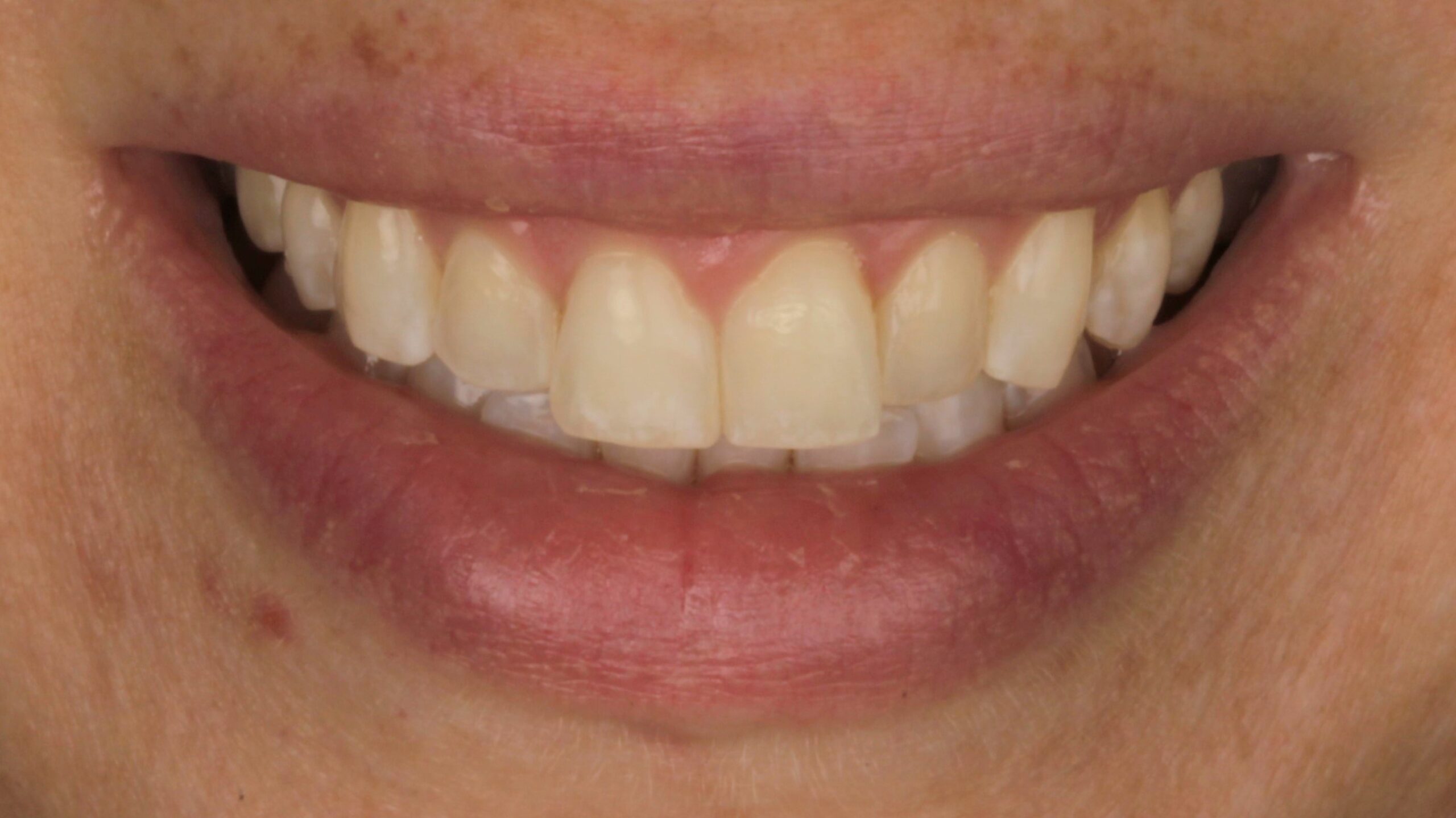 7 Veneers before 7 Veneers before