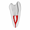 Premolar – Accessed, Merging canals, Radiopaque (White)