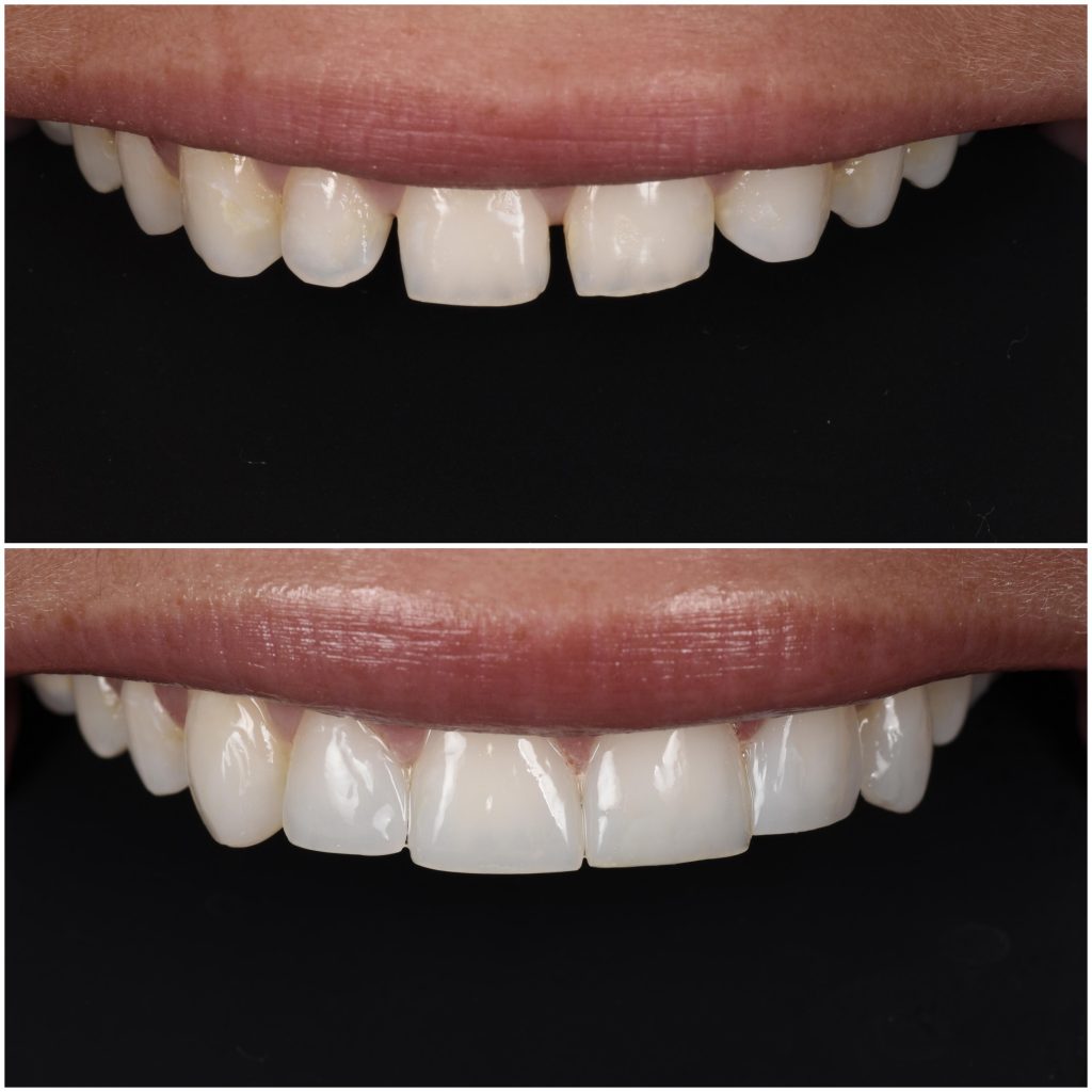 Non prep veneers før og etter bilde Eiksmarka Tannlegesenter