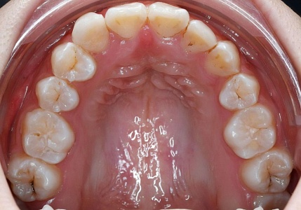 Usynlig tannregulering