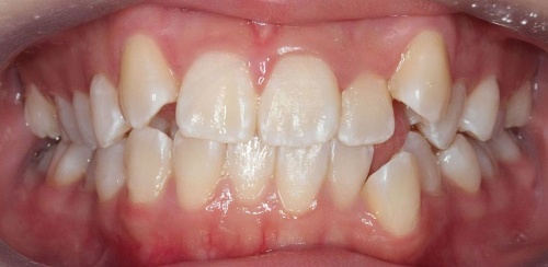 Usynlig tannregulering før behandling