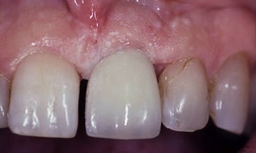 Pasient sin munn etter tannimplantat behandling