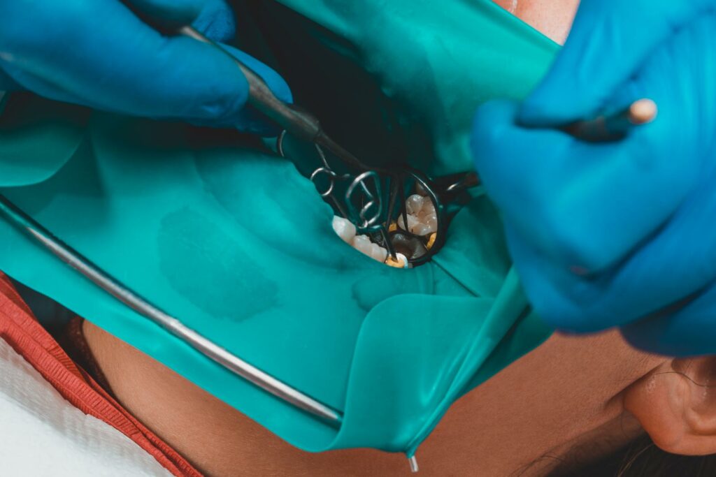 Tannfylling ved hull i tenner 92 41049784 restoration of a chewing surface by means of material for filling with photopolymer by means of the rubber dam system