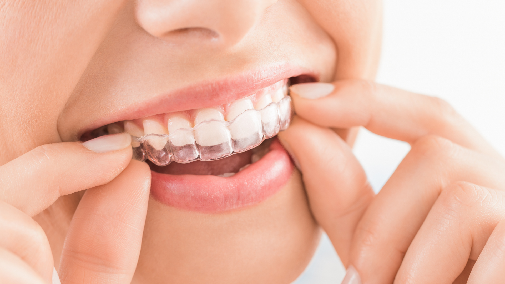 Kvinne setter inn en gjennomsiktig Invisalign-skinne over tennene for usynlig regulering