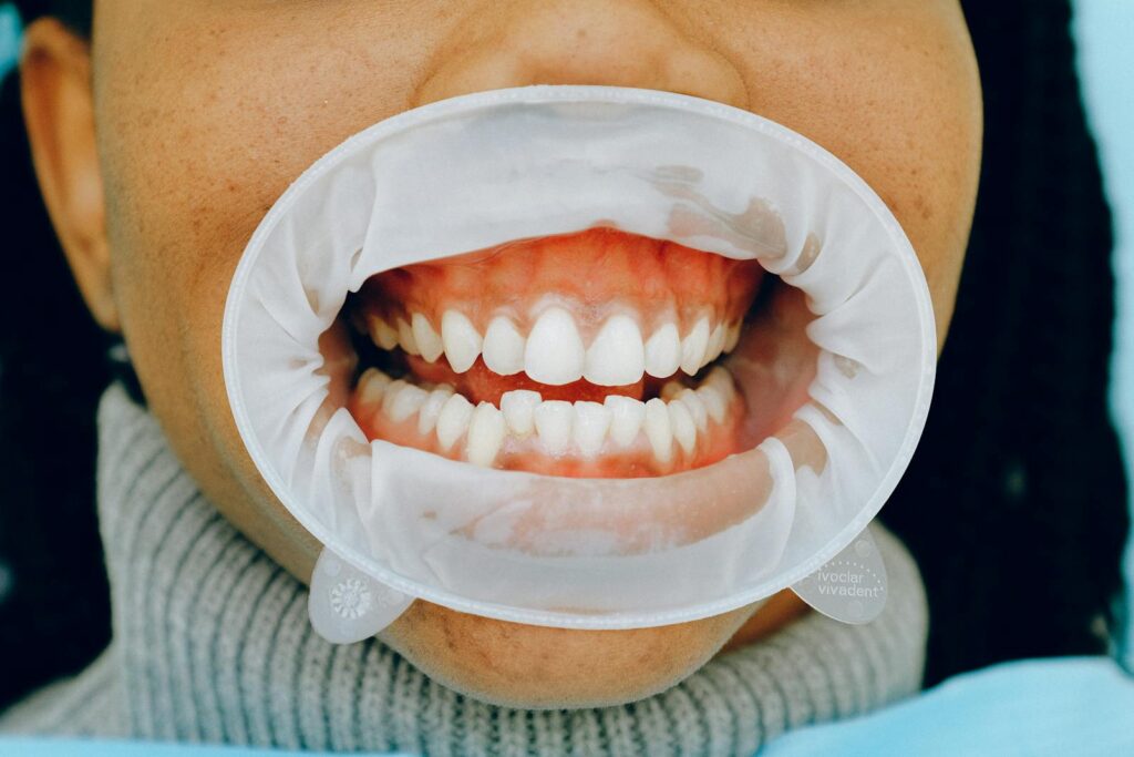 professional dental cleaning