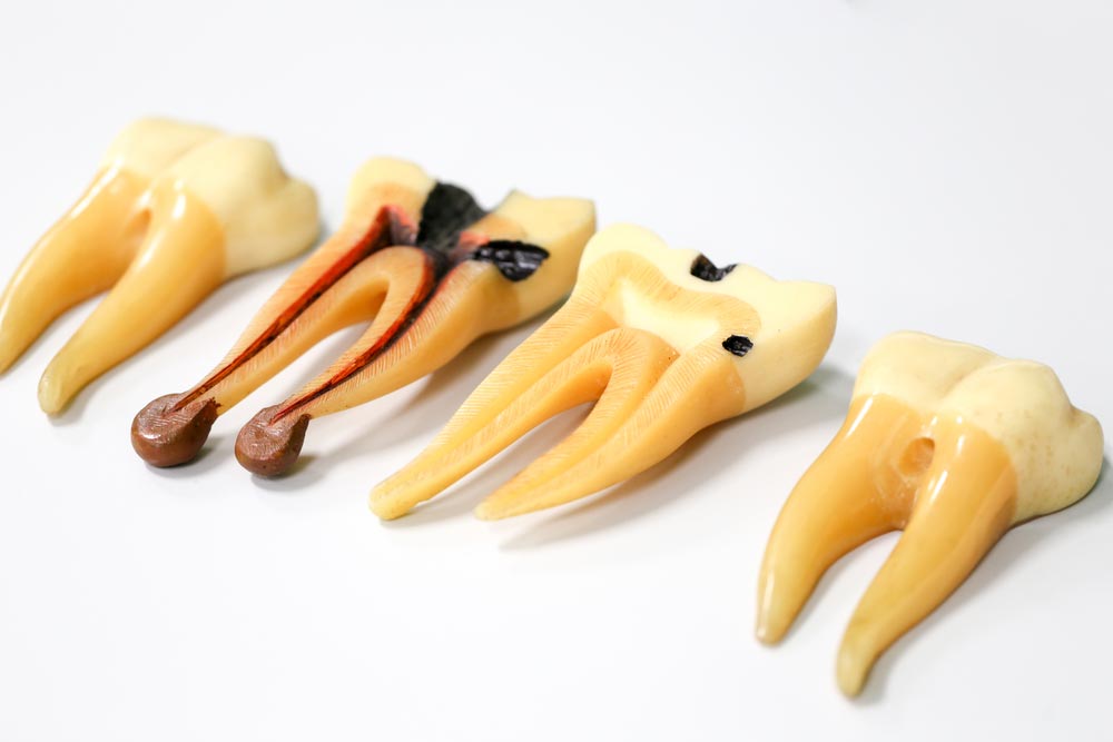 tooth decay explanation