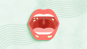 Illustrasjon av en åpen munn med betente mandler og hvite flekker som kan indikere infeksjon eller halsbetennelse.