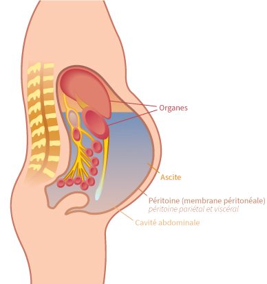 Ascite Ewimed