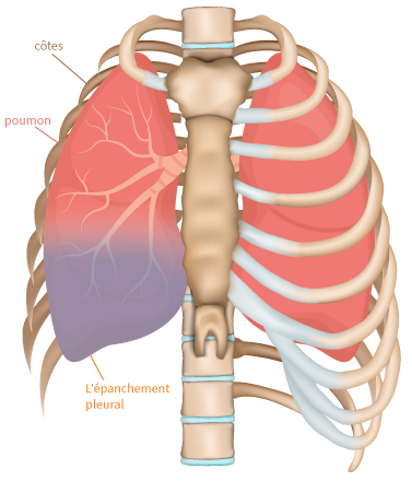 Epanchement pleural ou eau dans les poumons? | ewimed