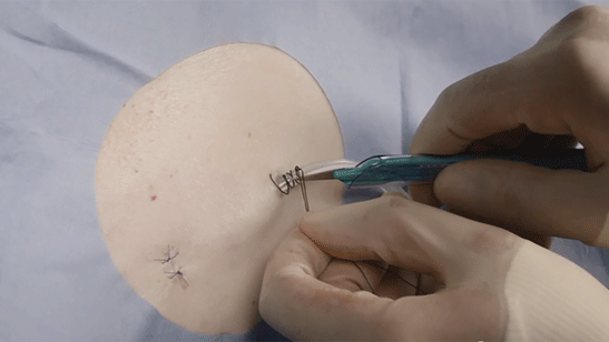 Implantation PleurX eller drainova kvarliggande kateter hudsutur och fixeringsstygn
