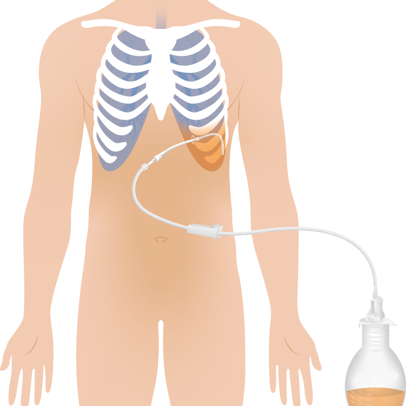 grafik på en människa med pleuravätska och en PleurX kateter kopplad till en vakuumflaska