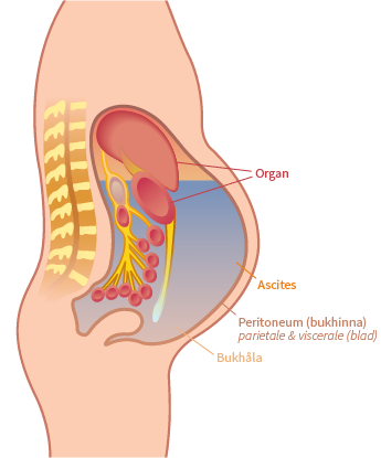 Peritoneum i genomskärning med ascites