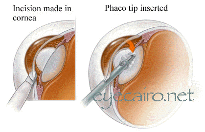 cataract surgery in Cairo