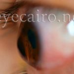 keratoconus treatment at best international standards at dr khalil eye clinic in Cairo, Egypt