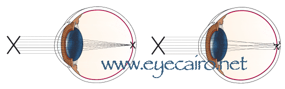 the picture on the right demosntrates the distorted eyesight noticed in cases with keratoconus