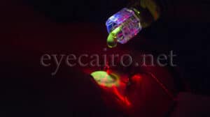 Under an ultraviolet light, drops of vitamin B2 (riboflavin) applied to the cornea, collagen cross linking in cairo by dr ahmad khalil