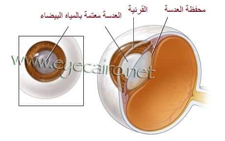 شرح تكون المياه البيضاء