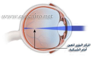 العين المصابة بقصر النظر أطول من العين الطبيعية