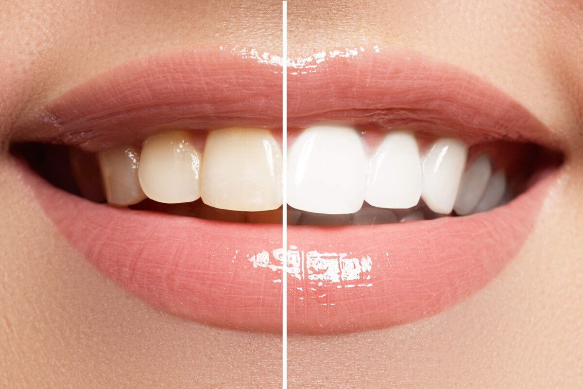 Teeth-Whitening.jpg