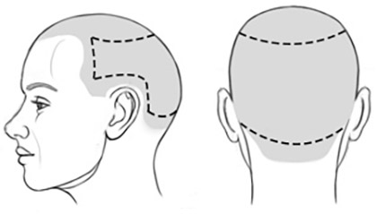 Prijs Micro Haar Pigmentatie extra zone