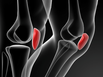 Patellofemoral