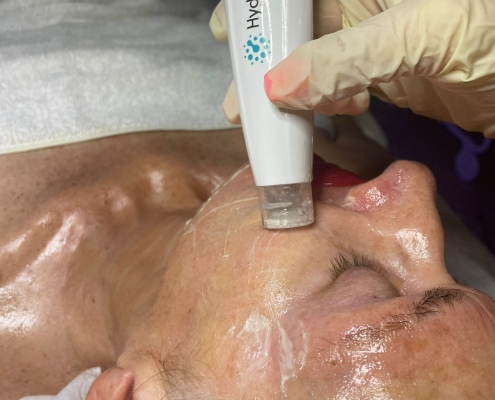MICRONEEDLING WITH THE DERMAPEN