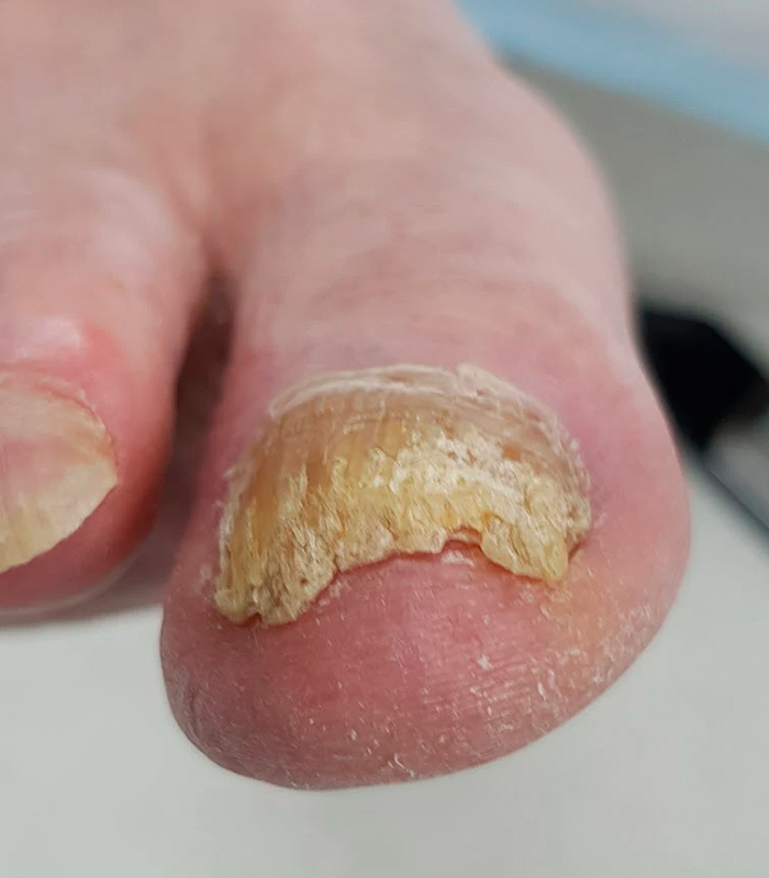 THICKENING toenail1